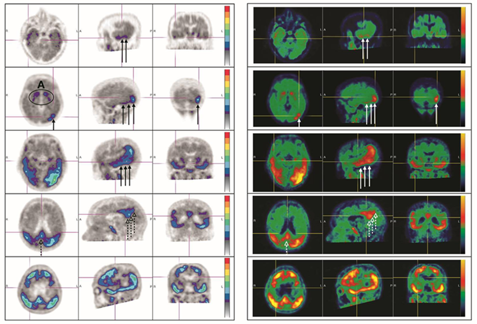 Figur 3. Exempel på bilder för AD-diagnostik