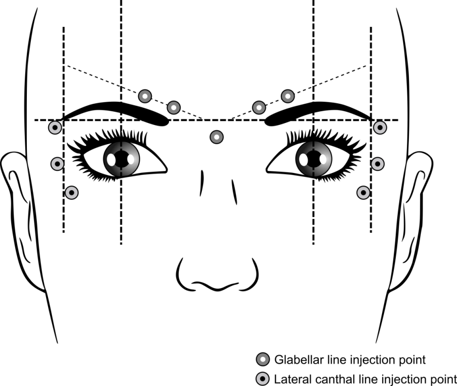 Rekommenderade injektionspunkter för glabellaveck och för rynkor vid sidan av ögonen