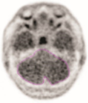 Figur 1: Exempel på område av intresse i cerebellum