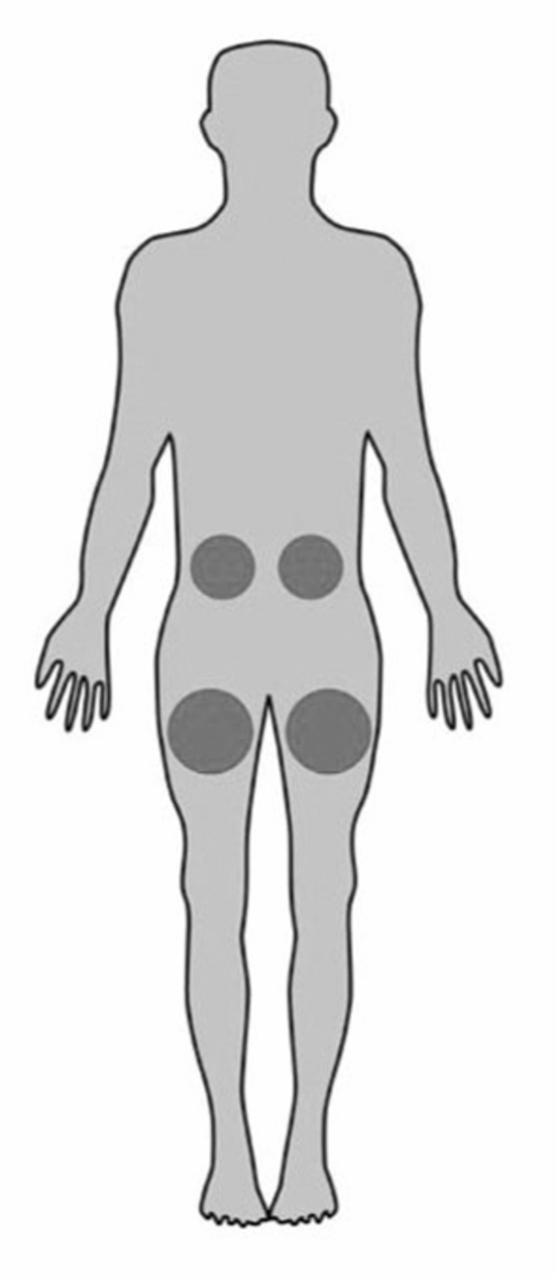 Bilden visar på lämpliga injektionsställen